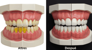 sarro en los dientes