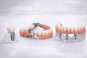 Prótesis Dentales en Sevilla
