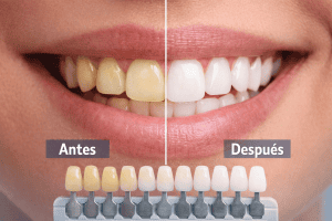 Blanqueamiento Dental